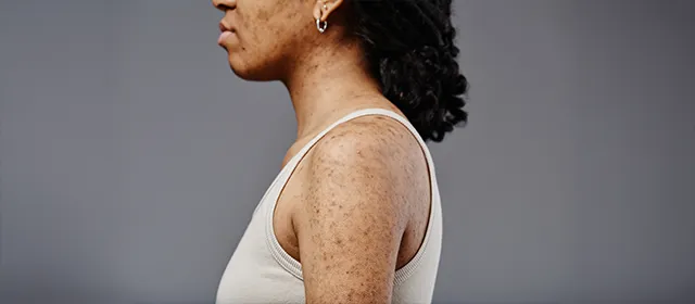 Porokeratosis: A Comprehensive Overview for Healthcare Professionals